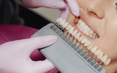 How to Choose the Perfect Veneers for Your Smile