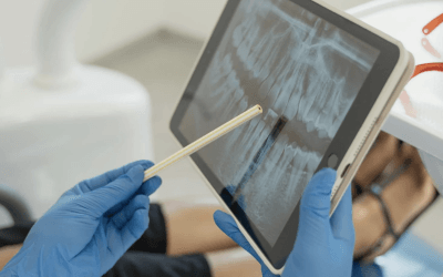 Things You Need to Know Before Having a Root Canal