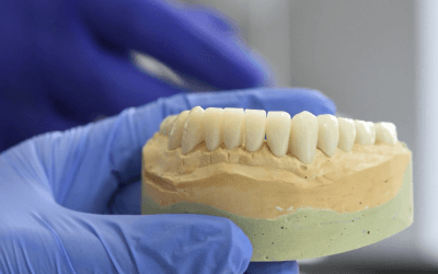 Things to Know Before Getting Dental Implants