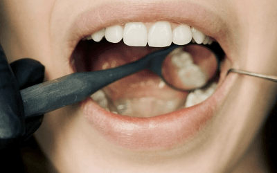 Understanding Tooth Fillings (Pasta) : Everything You Need to Know