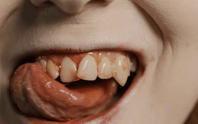 How to Prevent Periodontitis: Tips for Healthy Gums