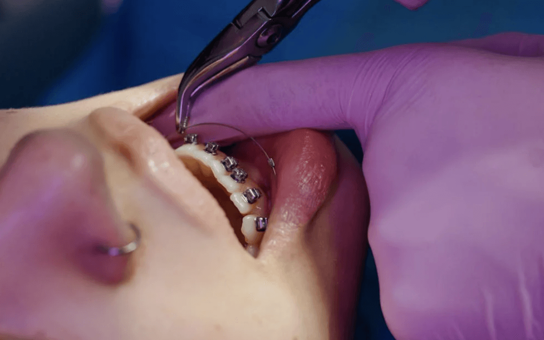 Things to Consider Before You Get Braces for Your Teeth