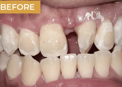 Adjustment Rotation of Tooth 21