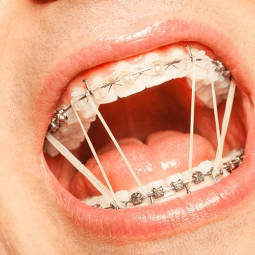 elastics