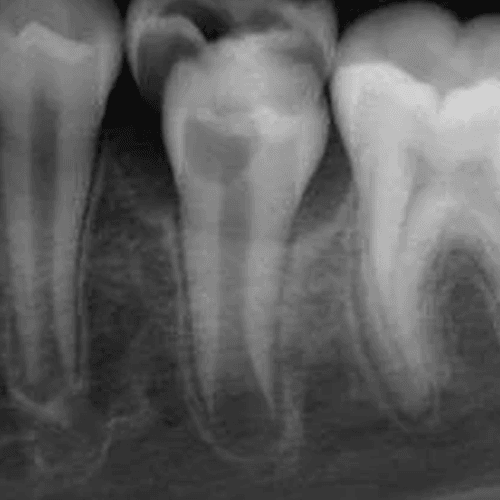 periapical xray