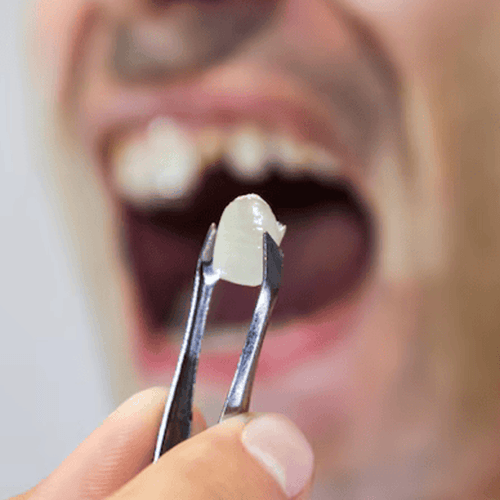 tooth extraction